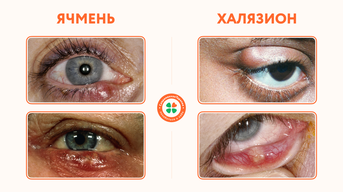 Разница халязиона и ячменя