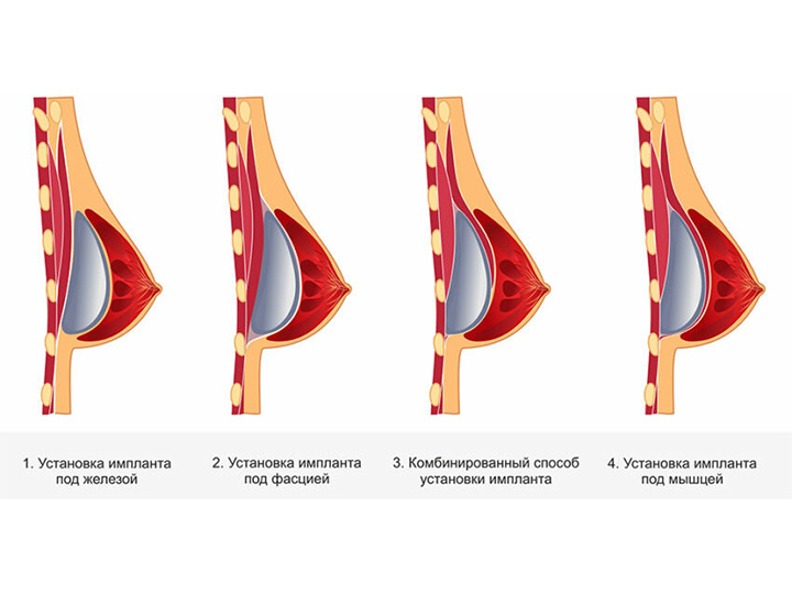 Дабл бабл маммопластика. Дабл бабл сделала пластическую операцию. Дабл бабл сделала пластическую операцию. Дабл бабл сделала пластическую операцию. Дабл бабл сделала пластическую операцию.
