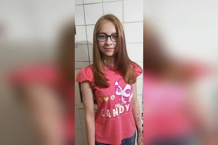 У 12-летней Иры обгорели уши, лицо, руки, зона декольте, пострадали глаза. Фото: из личного архива героев публикации.