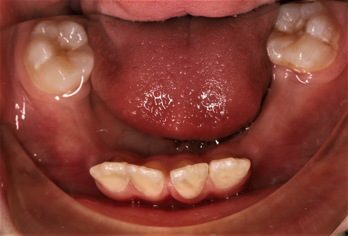 Пример ранней потери молочных зубов