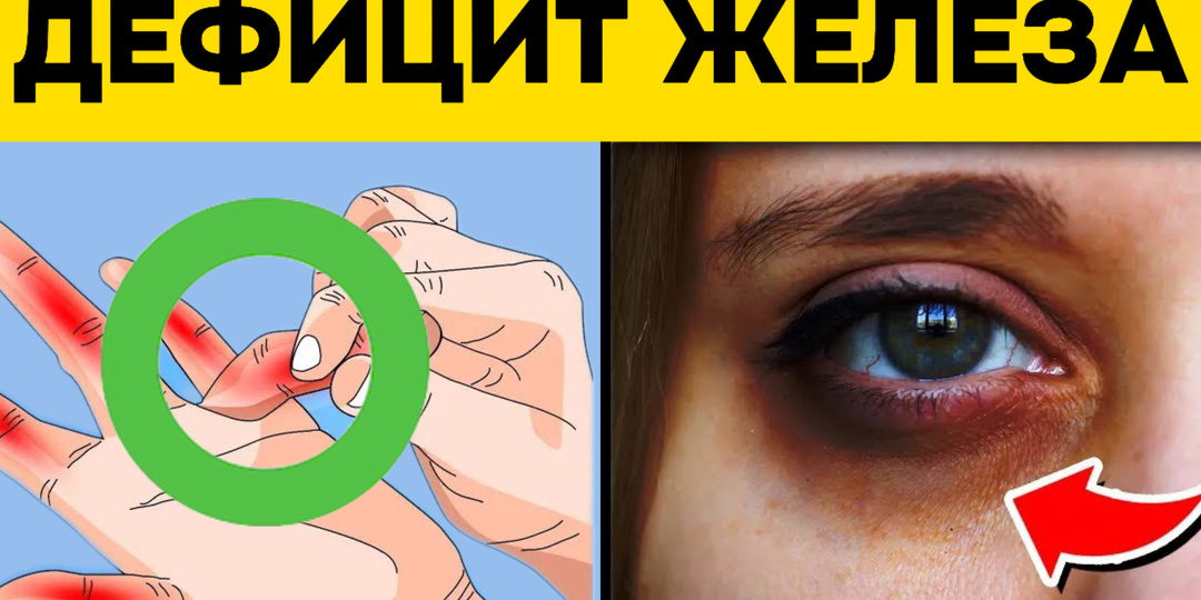 10 тревожных признаков того, что у вас дефицит железа (анемия)