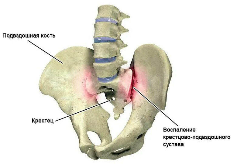 Блок крестцово-подвздошного сочленения: причины, симптомы и лечение
