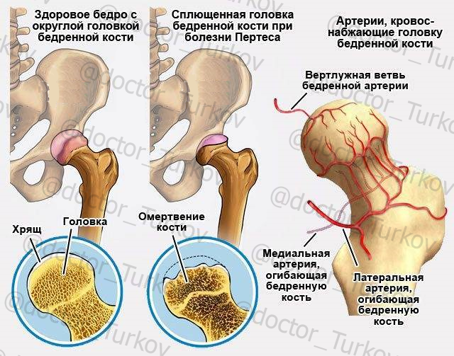 кровоснабжение головки бедренной кости и его влияние на формирование АНГБК