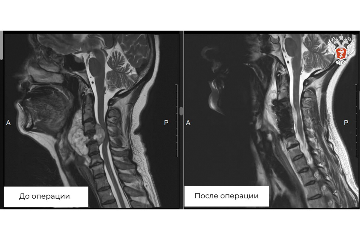 Минздрав России / Telegram📷Образование в шейном отделе позвоночника пациентки