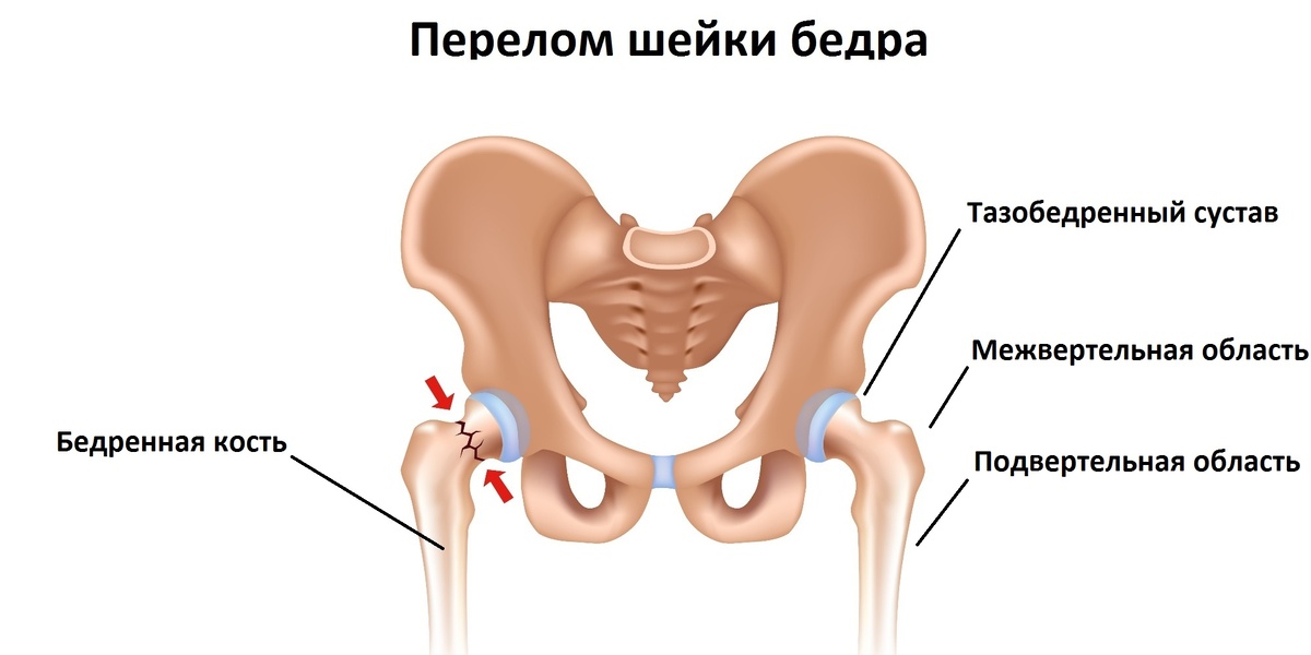 Перелом шейки бедра у пожилого человека. Скорая помощь КМС Медицина