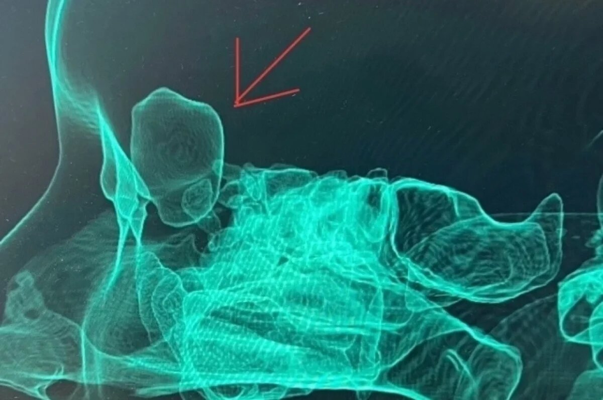    Врачи Удмуртии прооперировали мужчину, которого долго мучала головная боль