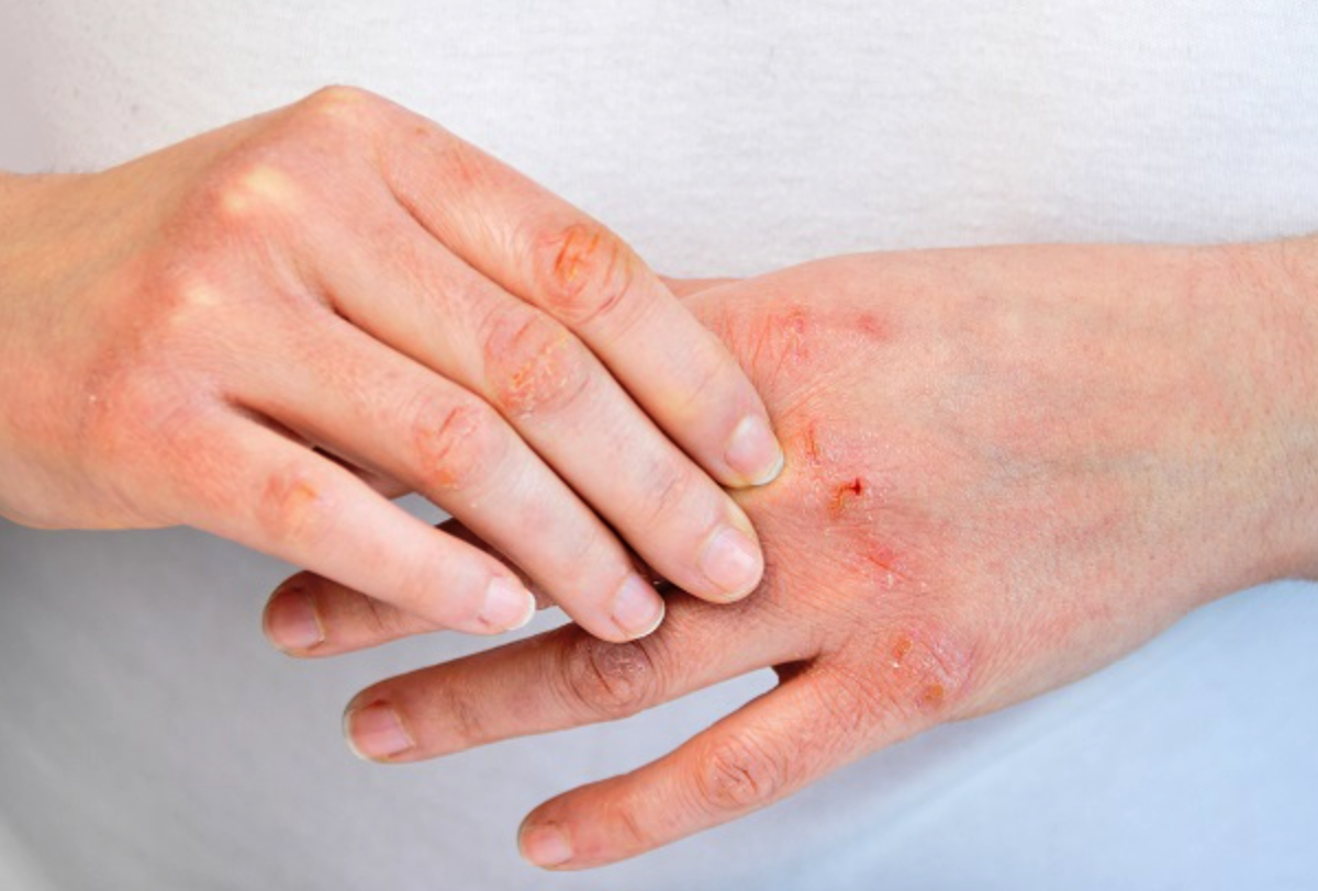 Нейродермит или атопический дерматит. Изображение с aurveda.ru