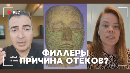 Филлеры 😢 Вызывают отеки и блокируют лимфатической систему?