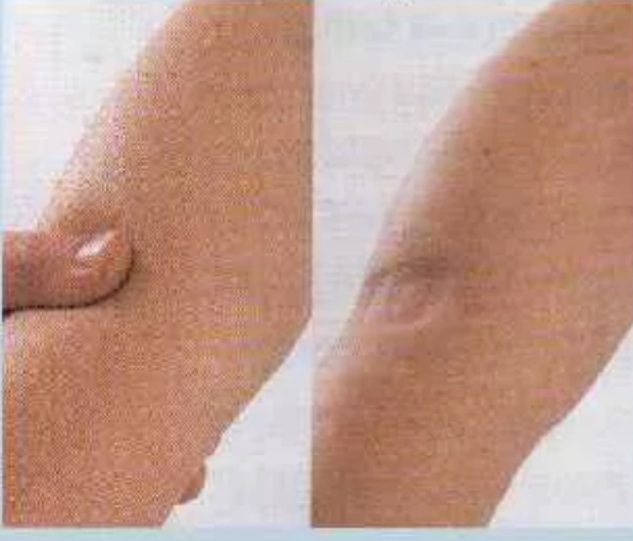 Тест на отечность