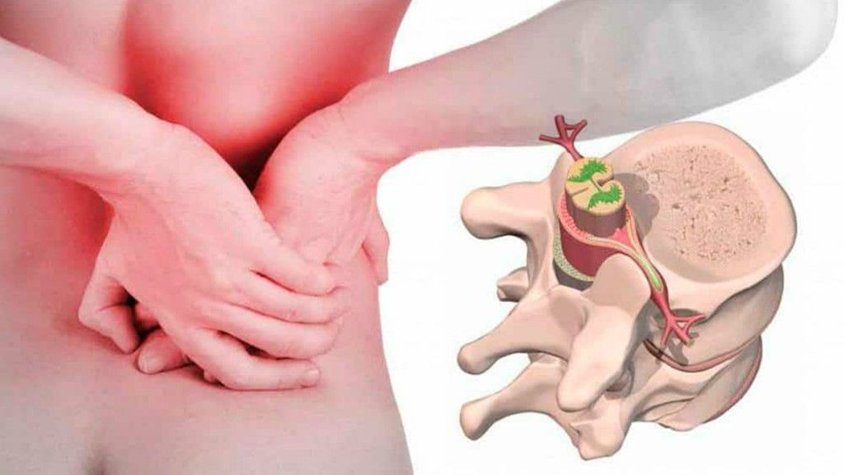 Грыжа в поясничном отделе