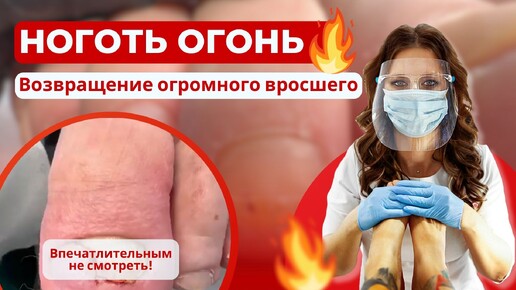 Ноготь Огонь: возвращение Огромного вросшего