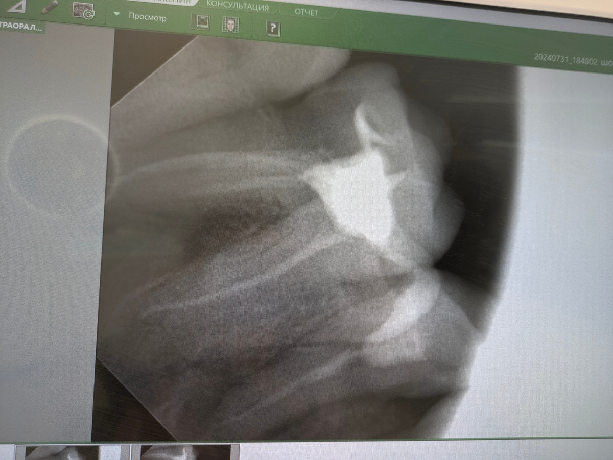 Снимок моего зуба из стоматологического кабинета