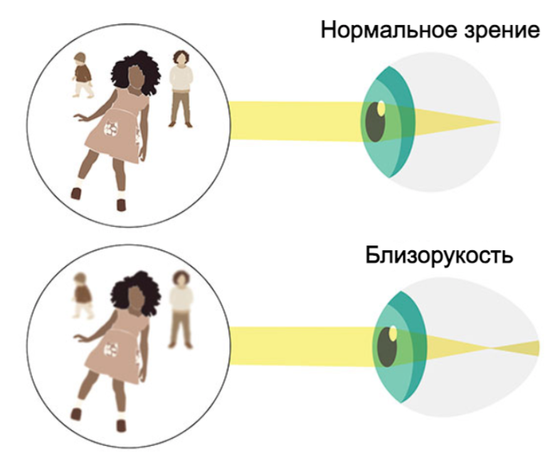 Близорукость