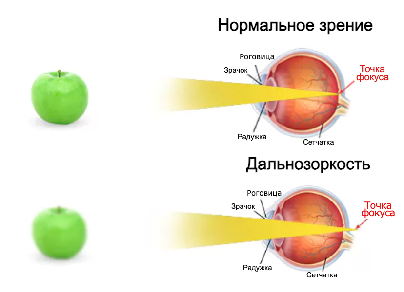 Дальнозоркость