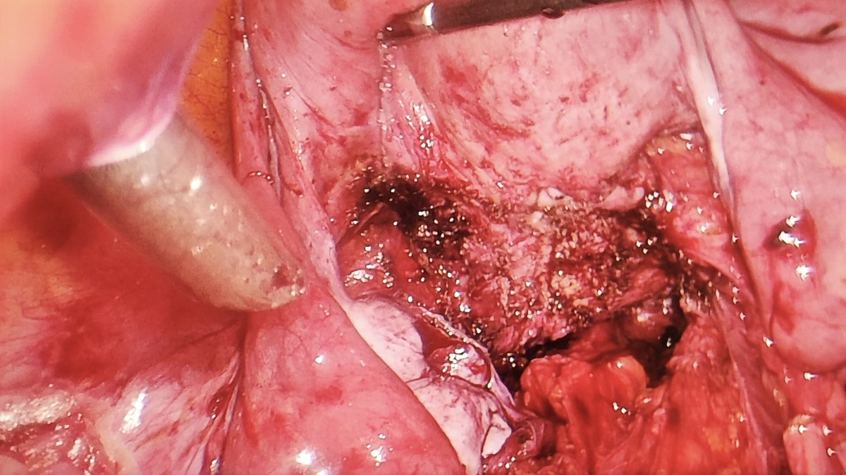 На фото результат иссечения инфильтрата позади матки