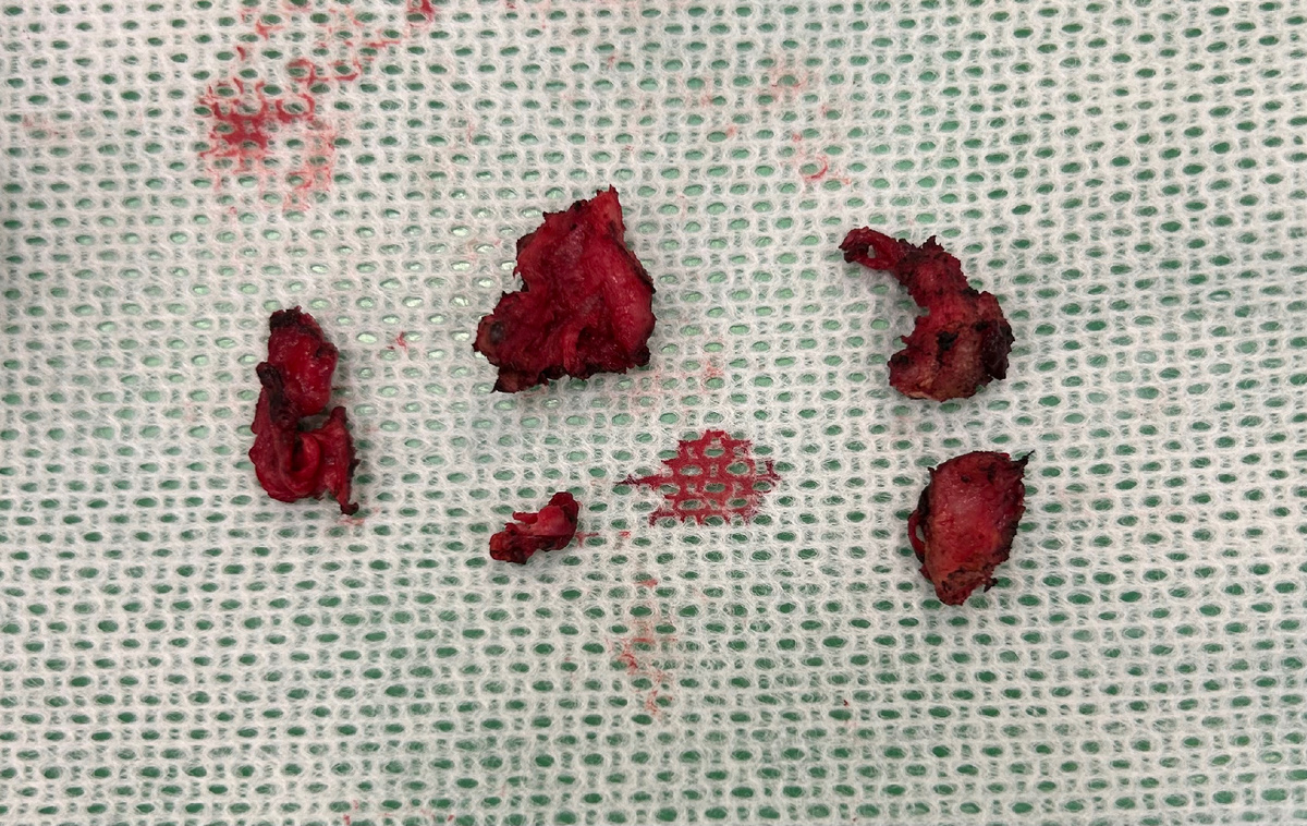 Удаленные инфильтраты