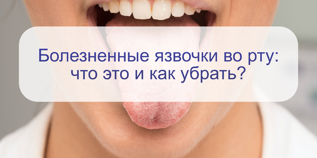 Язвочки в полости рта и на губах: это стоматит, герпес или другие болезни? Как убрать боль?