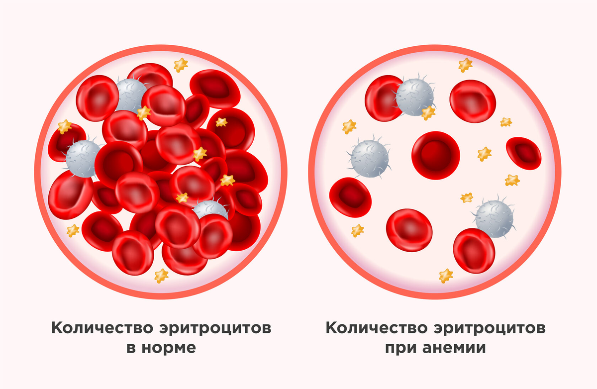 На этой иллюстрации представлены два изображения крови: одно демонстрирует количество эритроцитов в норме, а другое — при анемии. В норме количество эритроцитов (красных кровяных клеток) значительно больше, что позволяет крови эффективно транспортировать кислород по всему телу. В случае анемии количество эритроцитов заметно снижено, что приводит к ухудшению кислородного обмена и вызывает симптомы, такие как усталость, слабость и бледность кожи. Эта визуализация помогает понять, как анемия влияет на кровеносную систему и почему важно поддерживать нормальный уровень эритроцитов.