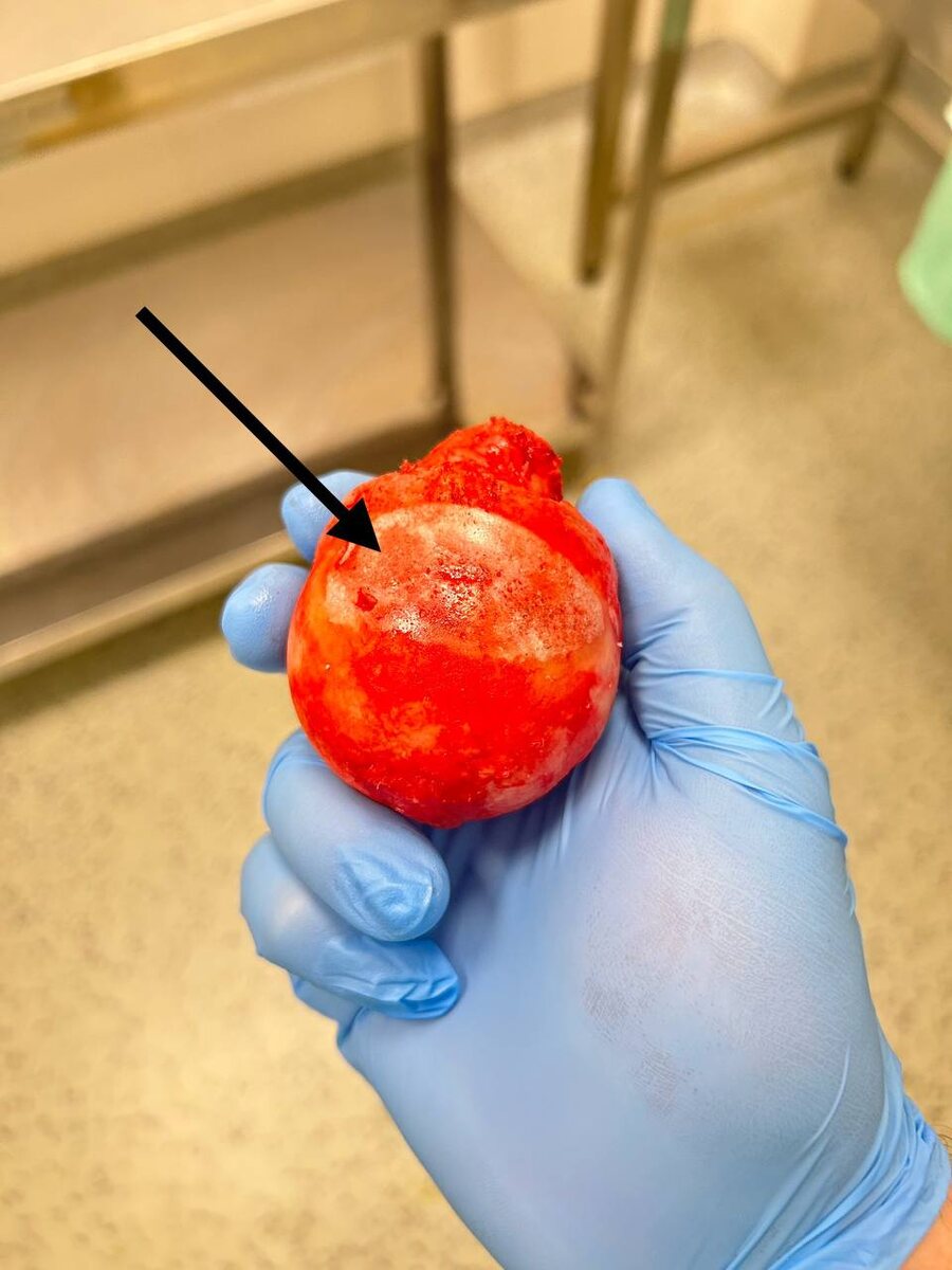 (Рис.1) Удаленная головка бедренной кости (объяснение в тексте)