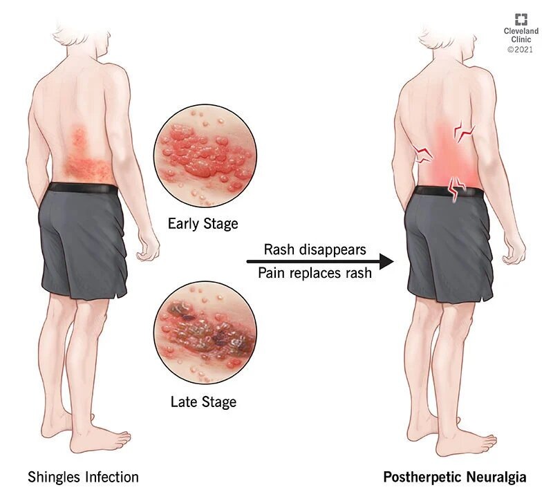 Источник: my.clevelandclinic.org