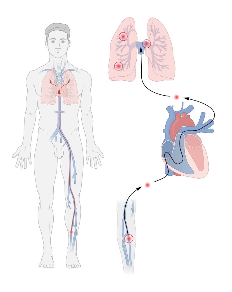 Легочная эмболия обычно возникает из тромбированных глубоких вен голени и перемещается к легким через нижнюю полую вену, правое предсердие, правый желудочек и легочные артерии. Эмбол может застрять в любом месте по пути к легким или внутри легочных артериол, в зависимости от его размера. Обычные места эмболии включают бифуркацию легочных артерий (седловидный тромб), внутри правой и/или левой легочной артерии и внутри долевой, сегментарной или субсегментарной ветви легочных артерий. Степень гемодинамического компромисса пропорциональна размеру сосуда, закупоренного легочной эмболией