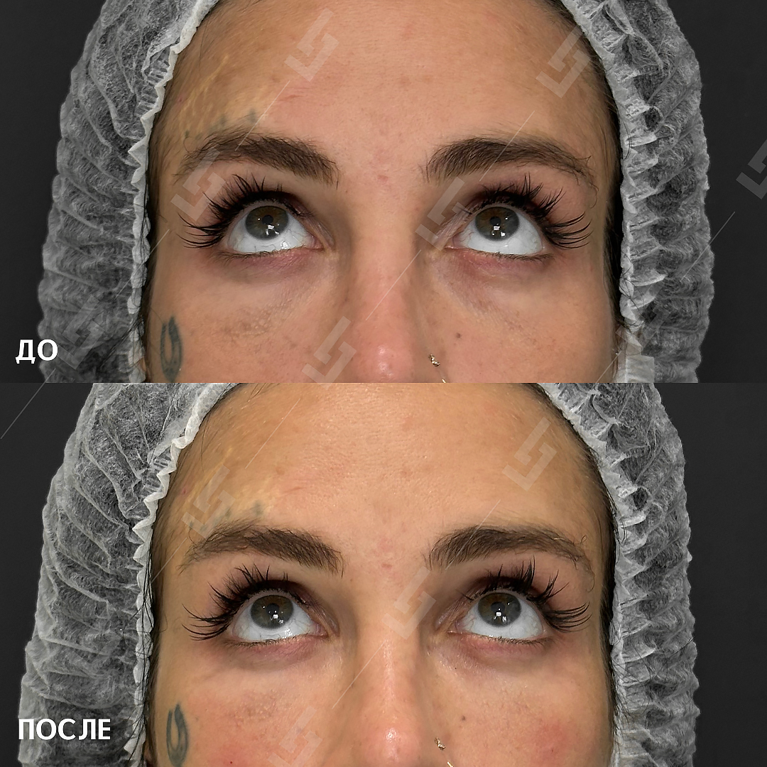 Результат процедуры в клинике LazerJazz