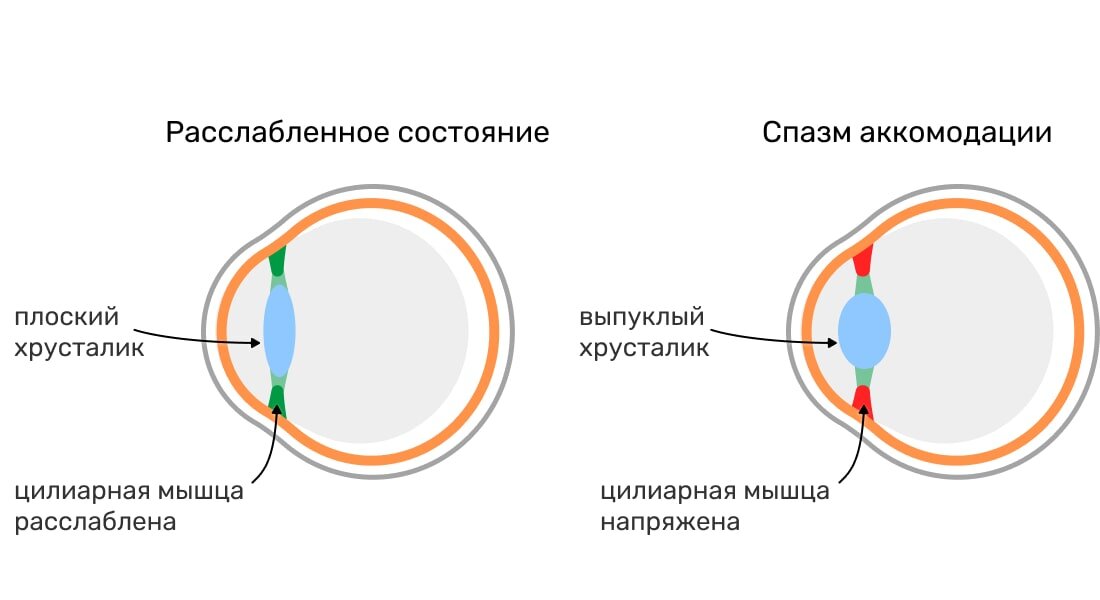 Источник https://happylook.ru/blog/zdorove-glaz/spazm-akkomodacii/