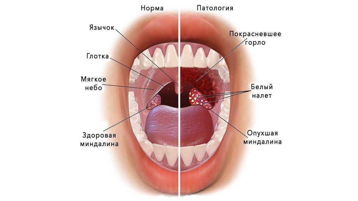 Ангионевротический отек гортани - чем опасен, как реагировать и как лечить?