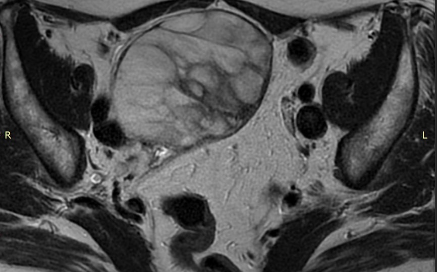 Кисты яичников