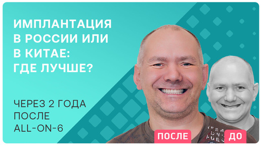 Descargar video: Отзыв пациента с Сахалина о том, где лучше проводить имплантацию зубов и почему