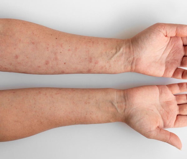 Грибковые заболевания кожи и их профилактика