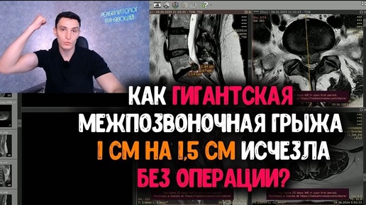 Грыжа гигант 1см на 1.5 см ушла без всего! КАК?