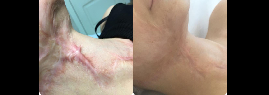 В качестве демонстрации приведем данный кейс. Очевидно, что это не растяжки, но тем не менее работа проделана невероятная. Сразу уточним, специалист подбирал курс из нескольких процедур, куда была включена методика Skinova Pro. Фото с сайта GEN87.RU 