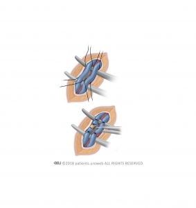 Рис. 2: Закупорка (рассечение) расширенных вен.