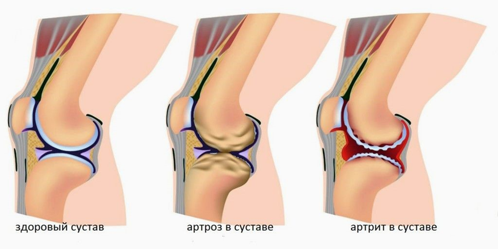Коленный сустав в разрезе