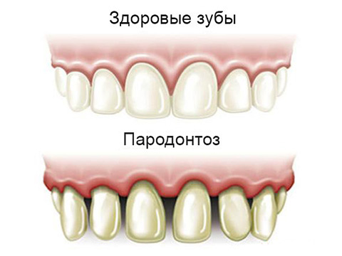 Профилактика пародонтоза