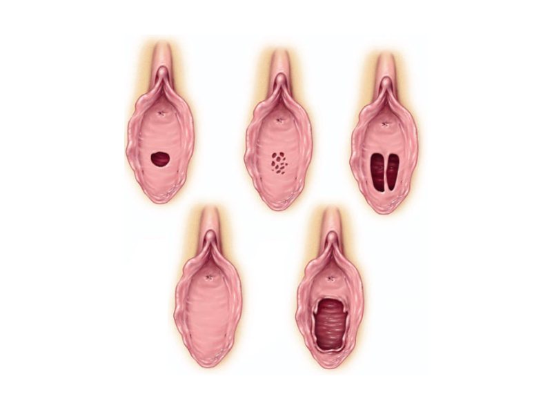 Вариаций нормального строения гимена довольно много. Редко, но встречаются и патологические формы. Если врожденные отверстия в плеве слишком маленькие (вариант 2) или их нет совсем (вариант 4) – менструальная кровь будет каждый месяц скапливаться во влагалище, вызывая боль и дискомфорт внизу живота. Но это лечится.