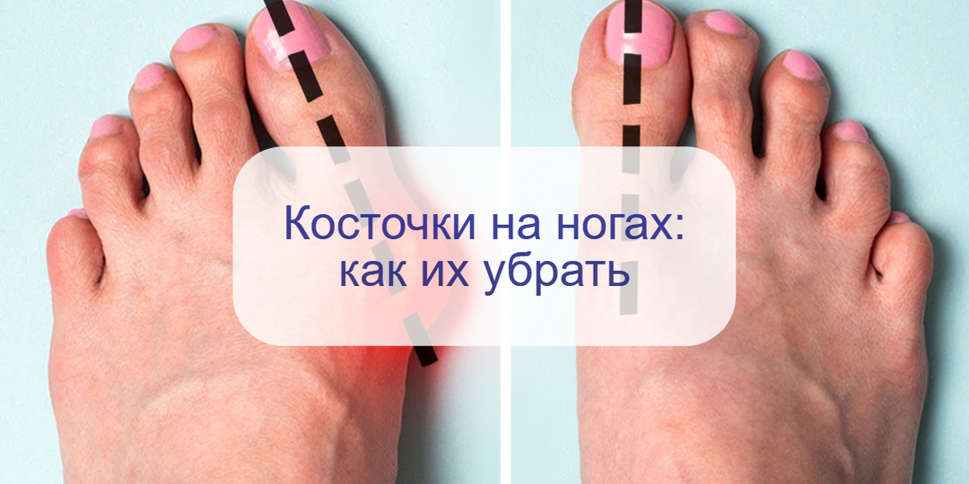 Если беспокоят «косточки» на ногах – врач объяснила, почему происходит деформация костей стопы