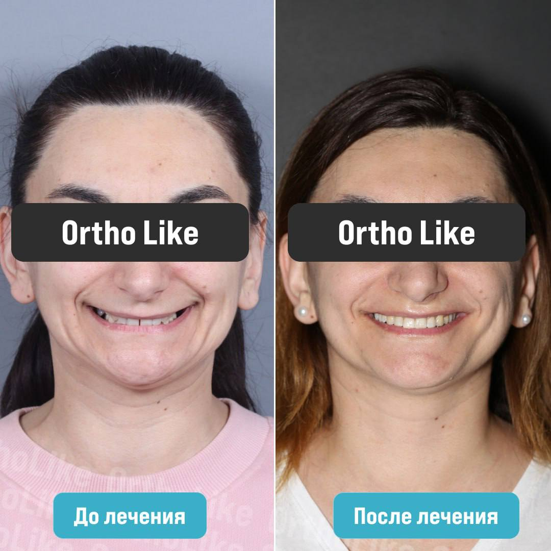Исправление дефектов зубочелюстной системы: до и после лечения
