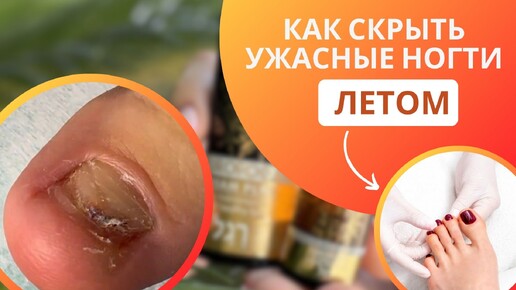 Как скрыть некрасивые ногти летом !