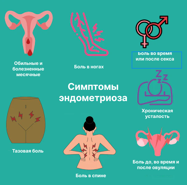 Симптомы эндометриоза