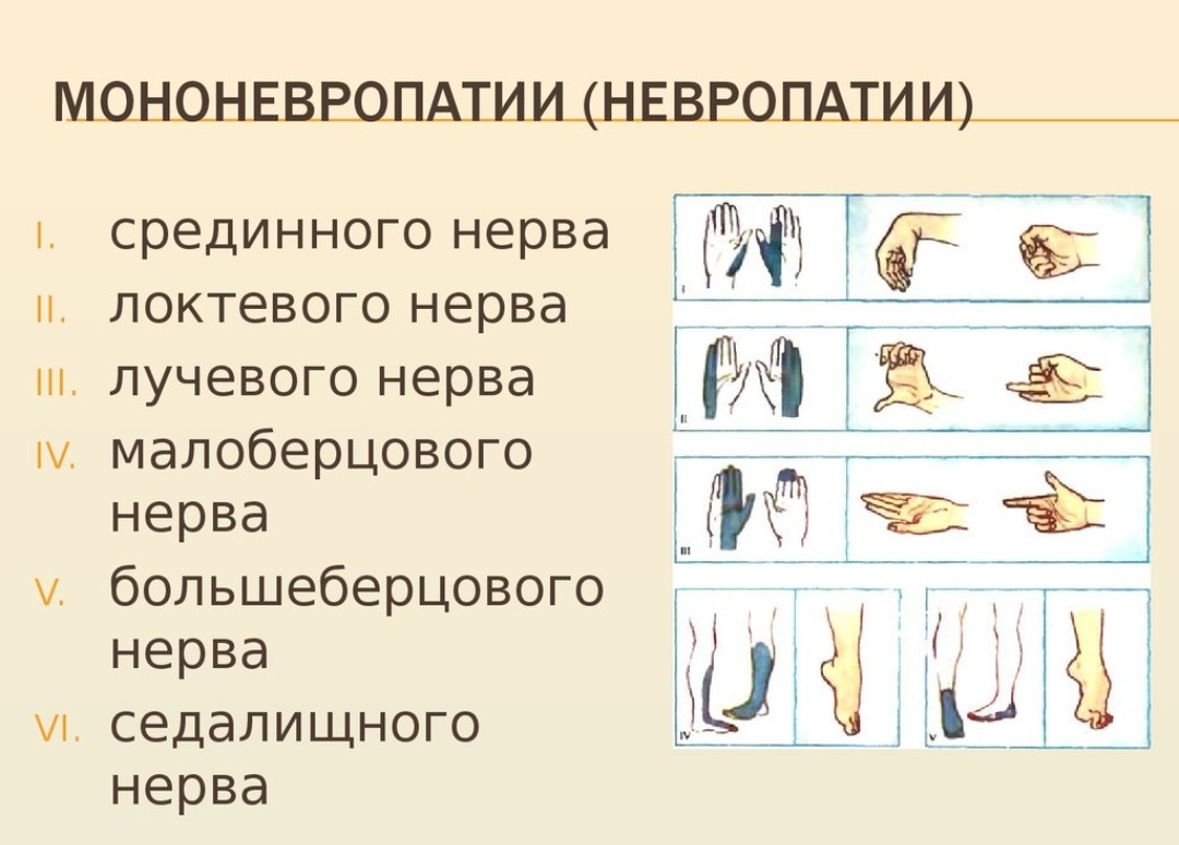Синдроме компрессии общего малоберцового нерва. Профилактика полинейропатии. Нейропатия малоберцового нерва симптомы. Классификация диабетической полинейропатии нижних конечностей. Симптомы характерные для полиневропатии.