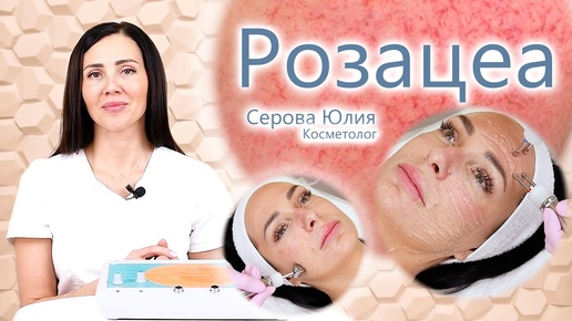 🔬 Розацеа - есть решение!