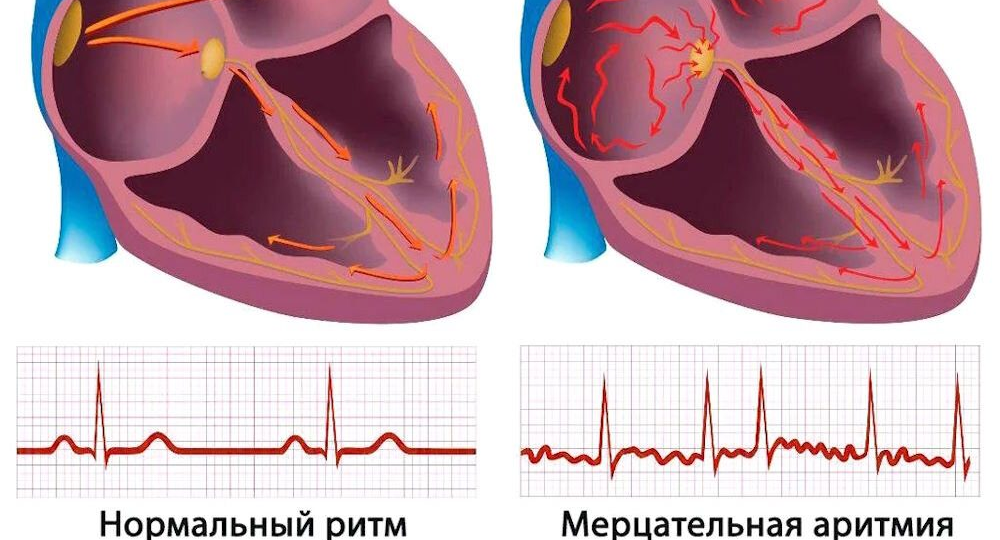 Постоянная форма мерцательной аритмии. Ответы на вопросы.