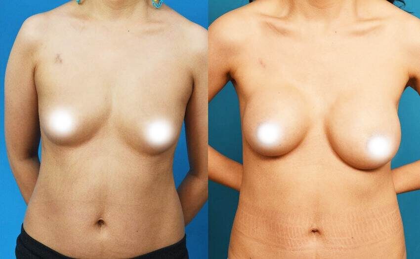 Через 3 месяца после первой операции у пациентки обнаружилась инфекция в правой молочной железе. На правой молочной железе появилась капсулярная контрактура IV степени