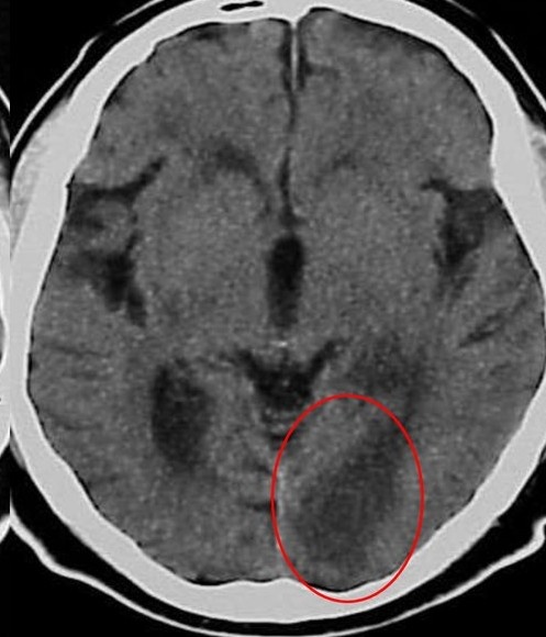 Зона пониженной плотности в затылочной области мозга в бассейне задней мозговой артерии слева