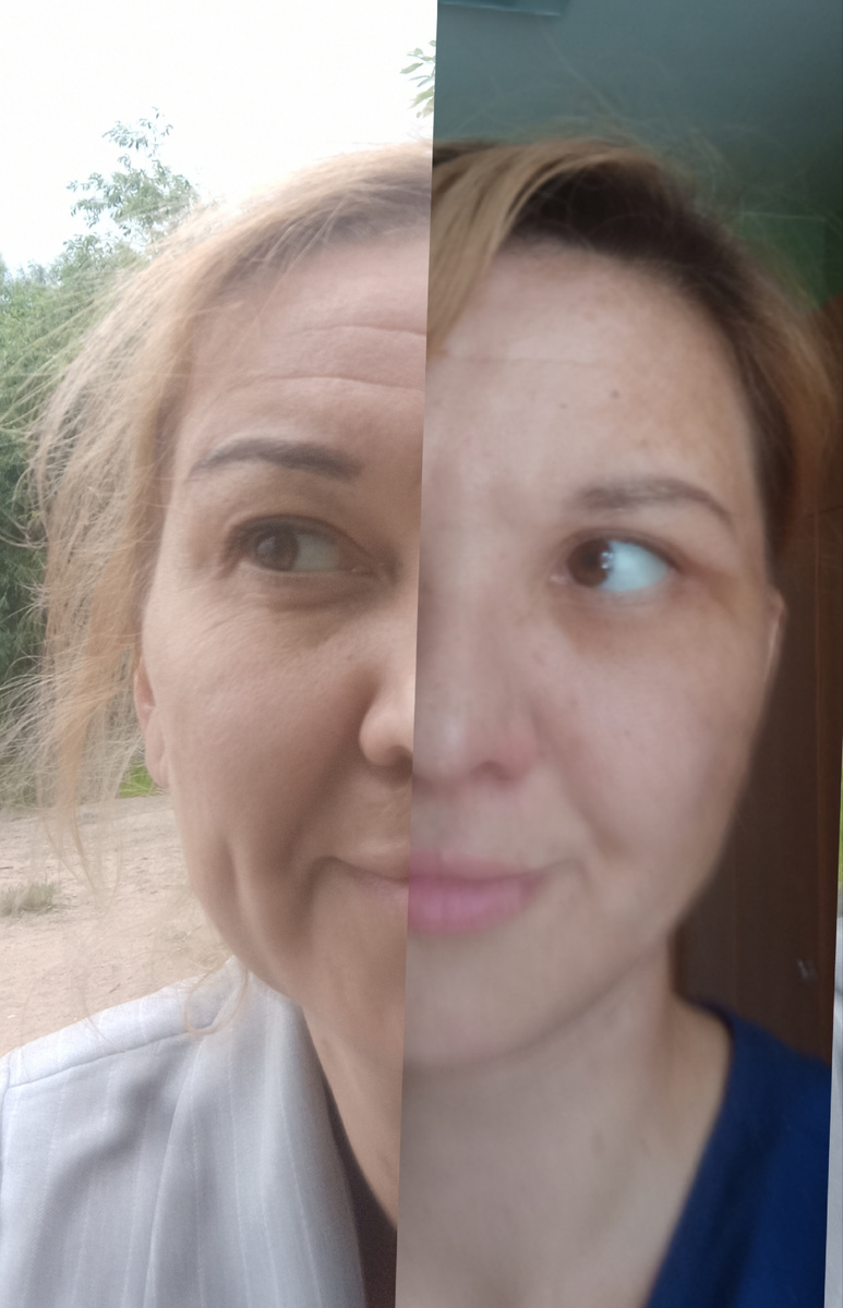 До операции - через месяц после операции