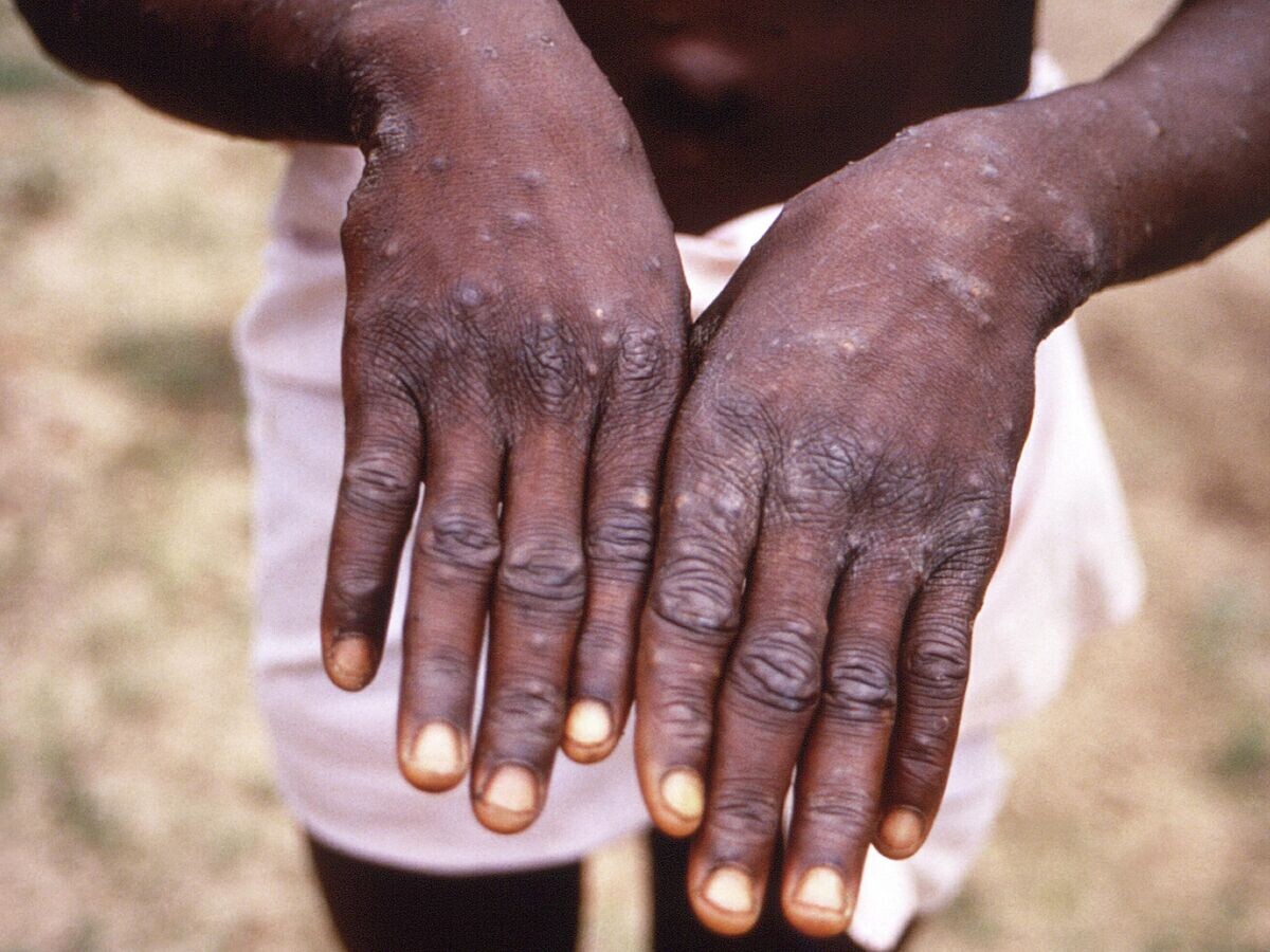    Руки пациента с обезьяньей оспой© AP Photo / CDC