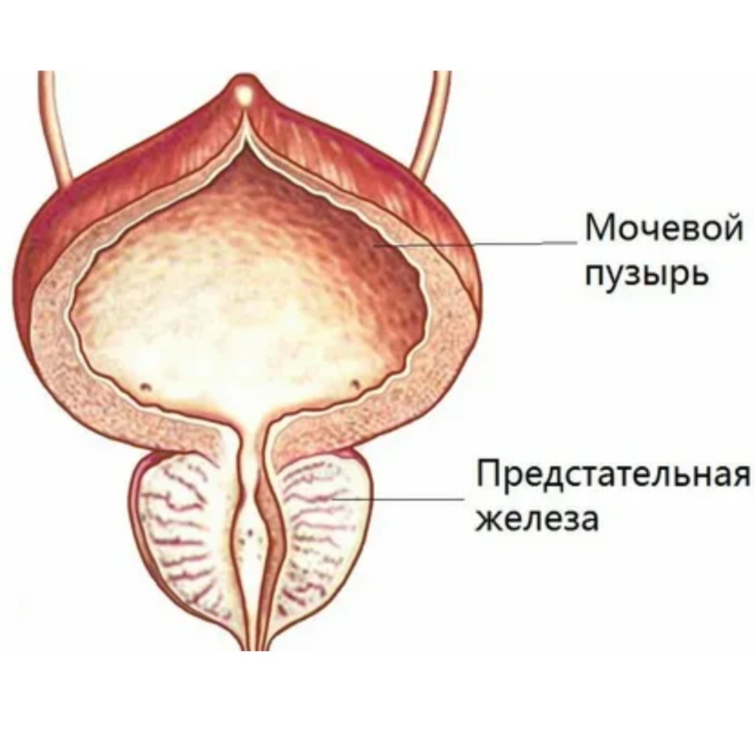 Уротелиальная карцинома мочевого пузыря. Дивертикул мочевого пузыря. Злокачественное новообразование мочевого пузыря. Застой в мочевом пузыре. Застой в мочевом пузыре.