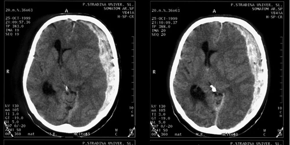 Вот так выглядит на КТ огромная субдуральная гематома слева... Яндекс-фото